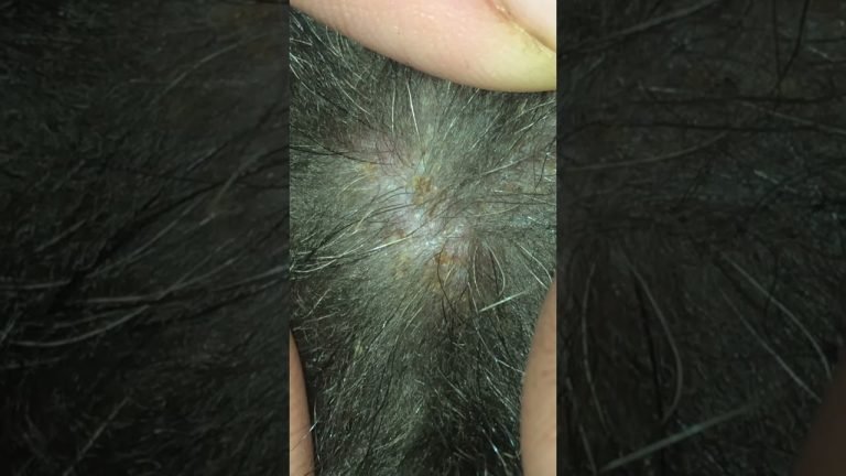 Cheyletiella Mite Bites: Pictures of Walking Dandruff on Humans